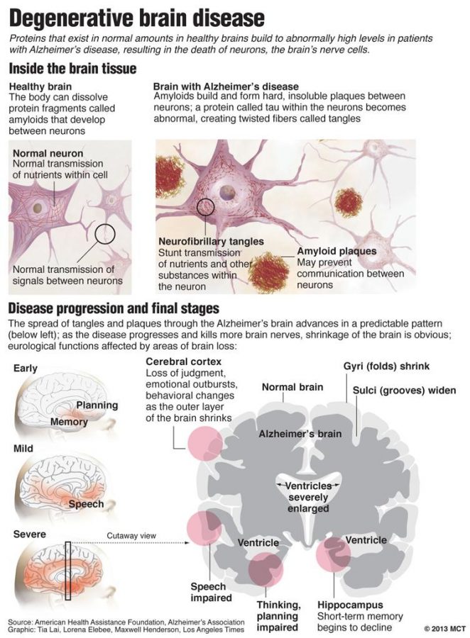 Illustrations comparing a normal and an Alzheimers brain and showing the progression of the disease. (Los Angeles Times/MCT)

