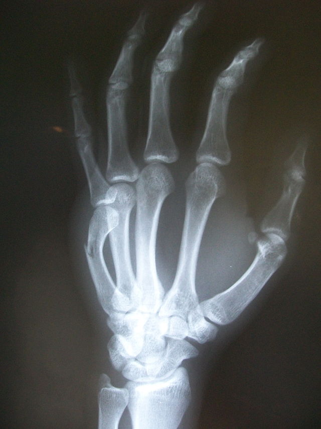 Lateral left hand x-ray showing fracture at the neck of the fifth metacarpal bone.