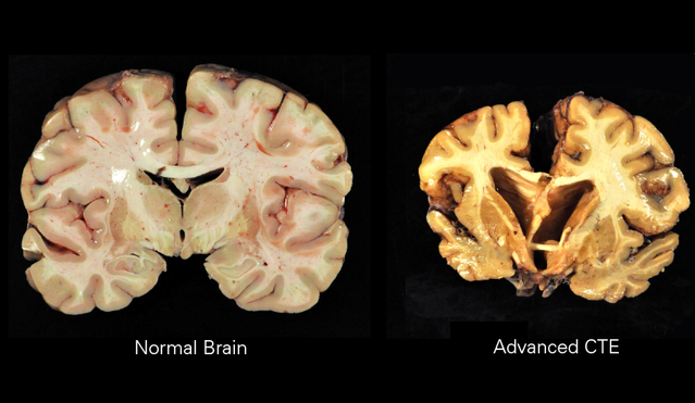 An image of chronic traumatic encephalopathy.